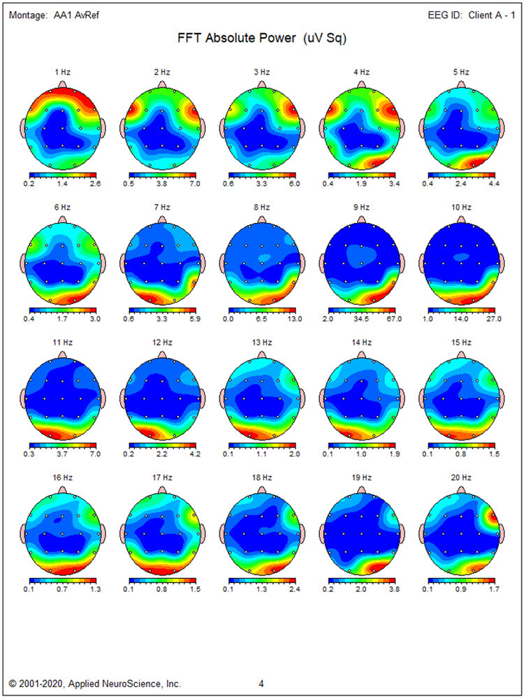 FFT absolute power topographic maps from first recording showing maximum voltage at O2 and T6